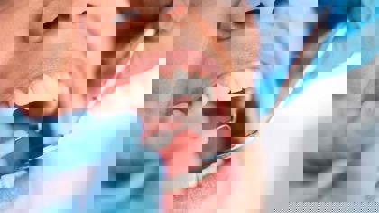 Applying the Texture Analyser to the dental industry: Compression, flexure and extrusion