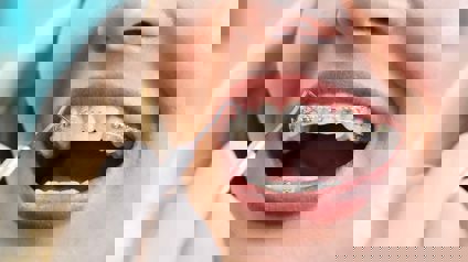 Person With Braces Being Examined By Orthodontist