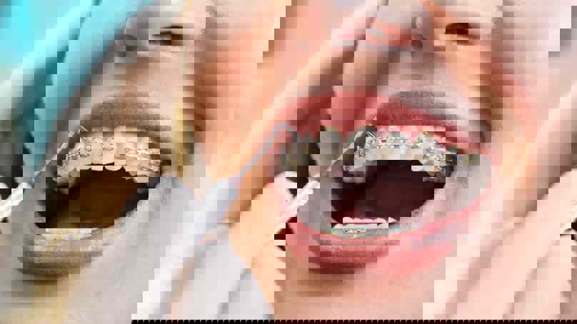 Person With Braces Being Examined By Orthodontist